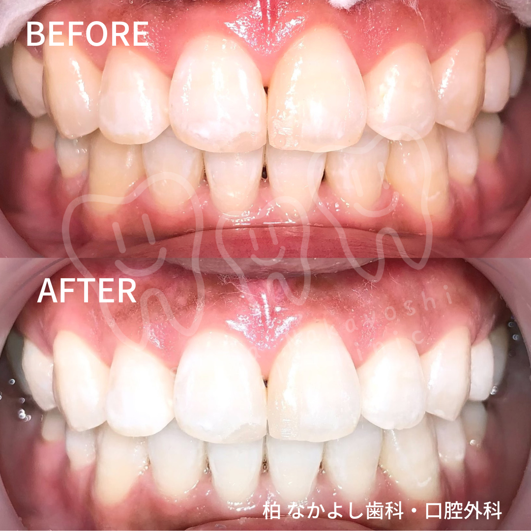 ホワイトニング　症例写真